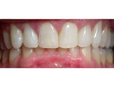 Invisalign to correct severe upper and and moderate lower crowding.