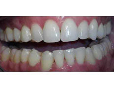 Invisalign to correct upper moderate spacing and sever lower crowding.