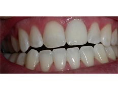 Zoom whitening treatment