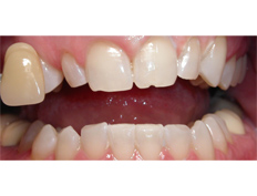 Zoom whitening treatment