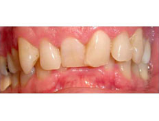 Invisalign to correct severe upper and and moderate lower crowding.