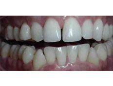 Invisalign to correct upper moderate spacing and sever lower crowding.