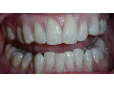 Invisalign to correct severe upper and lower crowding with arch construction.
