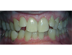 Invisalign to correct crowding.