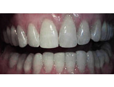 Invisalign to correct severe upper and lower crowding with arch construction.